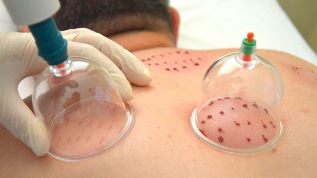 Treatments-Blood-Letting-1024×576 Treatments-Blood-Letting-1024x576